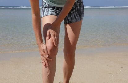 Painful varicose and spider veins on female legs. Keeping Active with Varicose Veins concept